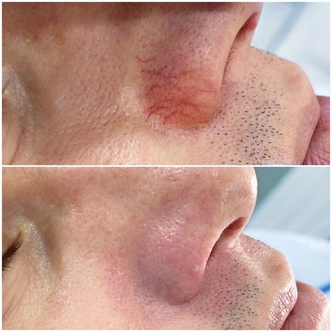 Процедура Эндосфера - аппаратный антицеллюлитный массаж тела: фото описание, плюсы и минусы